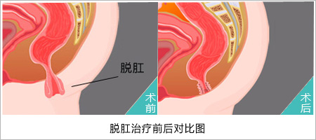 脱肛治疗前后对比.jpg